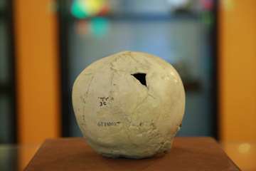 جمجمه  دختر 13 ساله(هیدروسفالی)