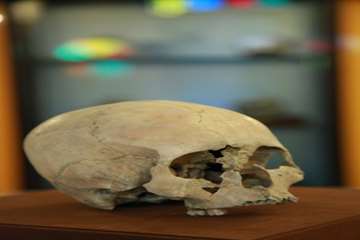 جمجمه  دختر 13 ساله(هیدروسفالی)